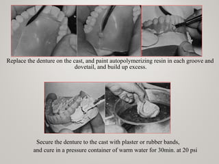 Replace the denture on the cast, and paint autopolymerizing resin in each groove and
dovetail, and build up excess.
www.indiandentalacademy.com
Secure the denture to the cast with plaster or rubber bands,
and cure in a pressure container of warm water for 30min. at 20 psi
 