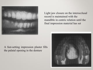 Light jaw closure on the interocclusal
record is maintained with the
mandible in centric relation until the
final impression material has set.
A fast-setting impression plaster fills
the palatal opening in the denture.
 