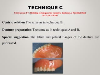 TECHNIQUE C
Centric relation The same as in technique B.
Denture preparation The same as in techniques A and B.
Special suggestion The labial and palatal flanges of the denture are
perforated.
Christensen FT: Relining techniques for complete dentures. J Prosthet Dent
1971;26:373-381
 