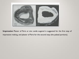 Impression Plaster of Paris or zinc oxide eugenol is suggested for the first step of
impression making, and plaster of Paris for the second step (the palatal portions).
 