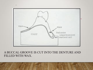 A BUCCAL GROOVE IS CUT INTO THE DENTURE AND
FILLED WITH WAX.
m
 
