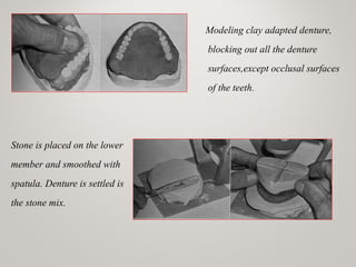 Modeling clay adapted denture,
blocking out all the denture
surfaces,except occlusal surfaces
of the teeth.
Stone is placed on the lower
member and smoothed with
spatula. Denture is settled is
the stone mix.
www.indiandentalacademy.com
 