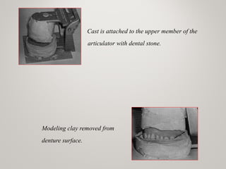 Cast is attached to the upper member of the
articulator with dental stone.
Modeling clay removed from
denture surface.
www.indiandentalacademy.com
 