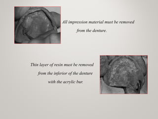 All impression material must be removed
from the denture.
Thin layer of resin must be removed
from the inferior of the denture
with the acrylic bur.
www.indiandentalacademy.com
 