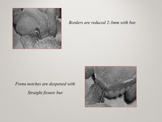 Borders are reduced 2-3mm with bur.
Frena notches are deepened with
Straight fissure bur.
www.indiandentalacademy.com
 