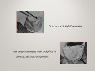 Paint cast with tinfoil substitute.
Mix autopolymerizing resin and place in
denture. Avoid air entrapment.
 