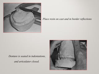 Place resin on cast and in border reflections
Denture is seated in indentations,
and articulator closed.
www.indiandentalacademy.com
 