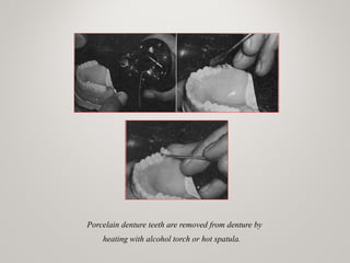 Porcelain denture teeth are removed from denture by
heating with alcohol torch or hot spatula.
 