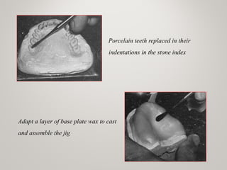 Porcelain teeth replaced in their
indentations in the stone index
Adapt a layer of base plate wax to cast
and assemble the jig
 