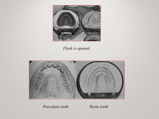 Flask is opened.
Porcelain teeth Resin teeth
 