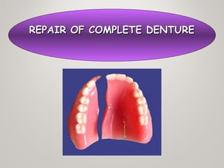 REPAIR OF COMPLETE DENTUREREPAIR OF COMPLETE DENTURE
 