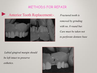 METHODS FOR REPAIR
► Anterior Tooth Replacement:- Fractured tooth is
removed by grinding
with no. 8 round bur.
Care must be taken not
to perforate denture base
Labial gingival margin should
be left intact to preserve
esthetics.
 