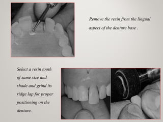 Remove the resin from the lingual
aspect of the denture base .
Select a resin tooth
of same size and
shade and grind its
ridge lap for proper
positioning on the
denture.
www.indiandentalacademy.com
 