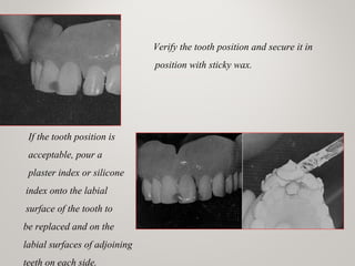 Verify the tooth position and secure it in
position with sticky wax.
If the tooth position is
acceptable, pour a
plaster index or silicone
index onto the labial
surface of the tooth to
be replaced and on the
labial surfaces of adjoining
teeth on each side.
 