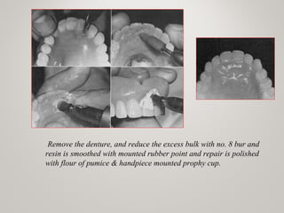 Remove the denture, and reduce the excess bulk with no. 8 bur and
resin is smoothed with mounted rubber point and repair is polished
with flour of pumice & handpiece mounted prophy cup.
 