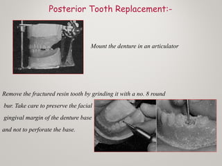 Posterior Tooth Replacement:-
Mount the denture in an articulator
Remove the fractured resin tooth by grinding it with a no. 8 round
bur. Take care to preserve the facial
gingival margin of the denture base
and not to perforate the base.
 