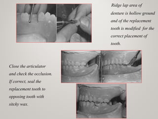 Ridge lap area of
denture is hollow ground
and of the replacement
tooth is modified for the
correct placement of
tooth.
Close the articulator
and check the occlusion.
If correct, seal the
replacement tooth to
opposing tooth with
sitcky wax.
 