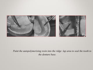 Paint the autopolymerising resin into the ridge lap area to seal the tooth to
the denture base.
 