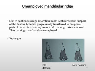 theories of impression making in complete denture | PPTX