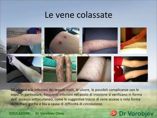 Le vene colassate
Gli ascessi e le infezioni dei tessuti molli, le ulcere, le possibili complicanze con le
sepsi. In particolare, frequenti infezioni nel posto di iniezione si verificano in forma
dell’ ascesso sottocutaneo, come le suggestive tracce di vene accese o nela forma
delle mani gonfie e blu a causa di difficoltà di circolazione.
EDUCAZONE: Dr Vorobiev Clinic
 