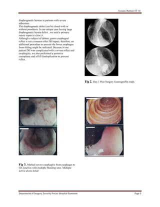 Aymane Basheer ET Al
Department of Surgery, Security Forces Hospital Dammam Page 3
diaphragmatic hernias in patients with severe
adhesions.
The diaphragmatic defect can be closed with or
without prosthesis. In our unique case having large
diaphragmatic hernia defect , we used a primary
suture repair to close it .
Although a subject of debate, gastro esophageal
reflux is very common after DH repair; therefore, an
additional procedure to prevent the lower esophagus
from sliding might be indicated. Because in our
patient DH was complicated with a severe reflux and
esophagitis, we also performed a posterior
cruroplasty and a Hill fundoplication to prevent
reflux.
Fig 3. Marked severe esophagitis from esophagus to
GE junction with multiple bleeding sites. Multiple
active ulcers noted
Fig 2. Day 1 Post Surgery Gastrograffin study
 