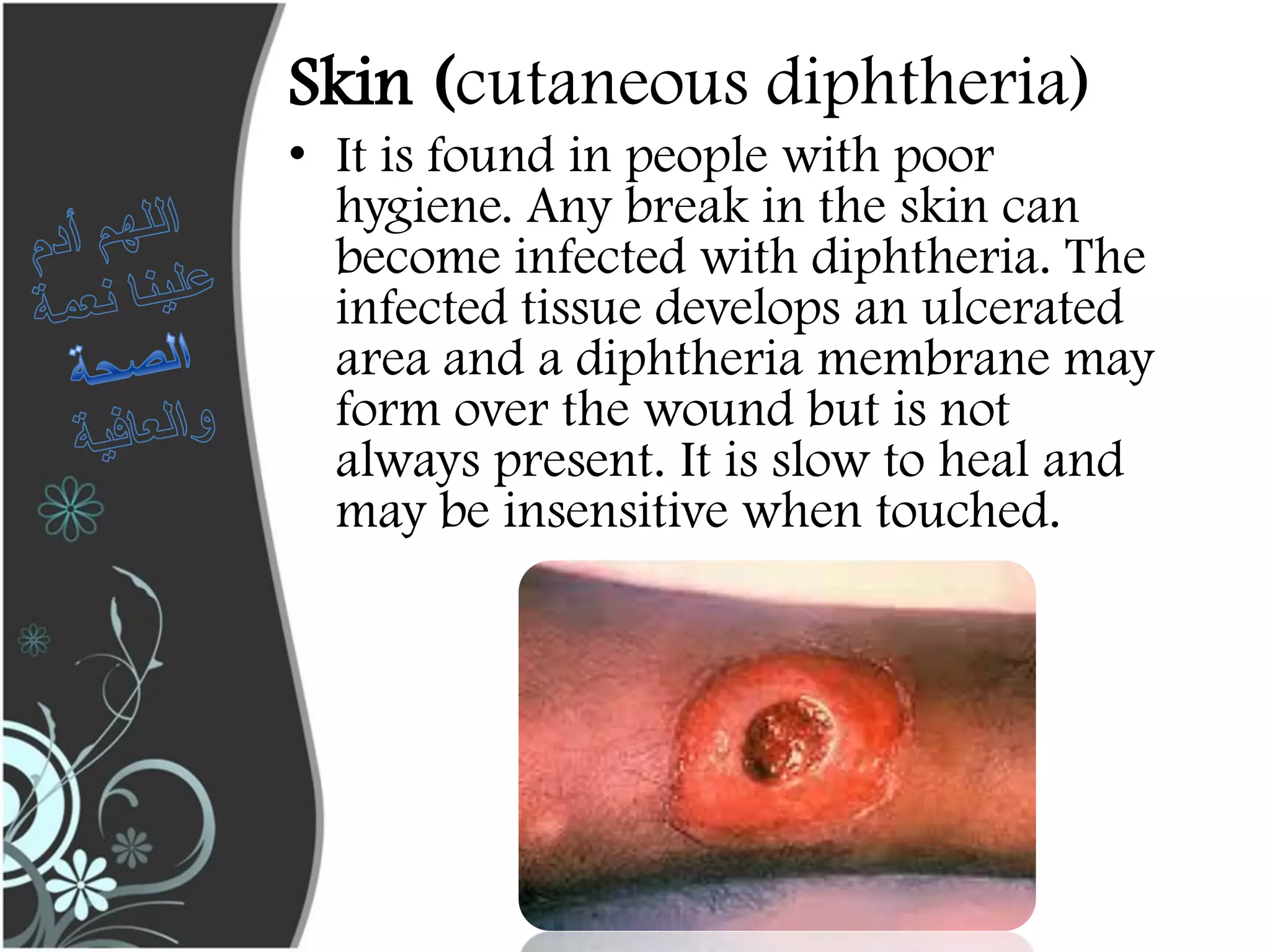 Diphtheria | PPT