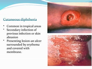 Cutaneous diphtheria
•
•
Common in tropical areas
Secondary infection of
previous infection or skin
abrasion
• Presenting lesion-an ulcer
surrounded by erythema
and covered with
membrane.
 