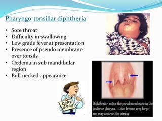Pharyngo-tonsillar diphtheria
• Sore throat
• Difficulty in swallowing
• Low grade fever at presentation
• Presence of pseudo membrane
over tonsils
• Oedema in sub mandibular
region
• Bull necked appearance
 