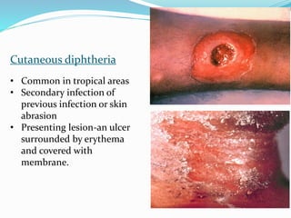 Cutaneous diphtheria
• Common in tropical areas
• Secondary infection of
previous infection or skin
abrasion
• Presenting lesion-an ulcer
surrounded by erythema
and covered with
membrane.
 