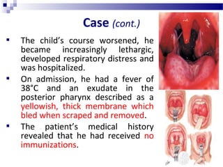 Case (cont.)
 The child’s course worsened, he
became increasingly lethargic,
developed respiratory distress and
was hospitalized.
 On admission, he had a fever of
38°C and an exudate in the
posterior pharynx described as a
yellowish, thick membrane which
bled when scraped and removed.
 The patient’s medical history
revealed that he had received no
immunizations.
 