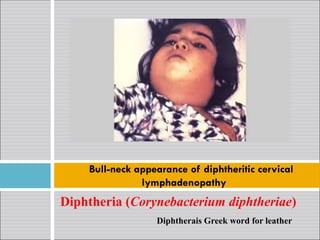 Diphtheria (Corynebacterium diphtheriae)
Diphtherais Greek word for leather
Bull-neck appearance of diphtheritic cervical
lymphadenopathy
 