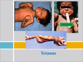 Tetanus
LOCKJAW
 