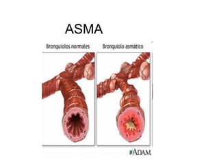 ASMA
 