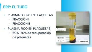 PRP: EL TUBO
▫ PLASMA POBRE EN PLAQUETAS
▫ FRACCIÓN I
▫ FRACCIÓN II
▫ PLASMA RICO EN PLAQUETAS
▫ 60%-70% de recuperación
de plaquetas
 