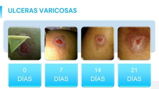 0
DÍAS
7
DÍAS
14
DÍAS
21
DÍAS
ULCERAS VARICOSAS
 
