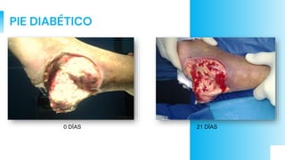 PIE DIABÉTICO
0 DÍAS 21 DÍAS
 