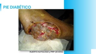 PIE DIABÉTICO
INJERTO AUTOLOGO y PRP (30 DÍAS)
 