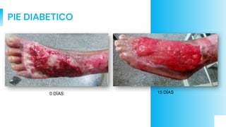 PIE DIABETICO
0 DÍAS 15 DÍAS
 