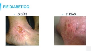 PIE DIABETICO
▫ 0 DÍAS ▫ 21 DÍAS
 