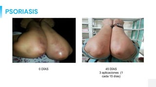 PSORIASIS
0 DÍAS 45 DÍAS
3 aplicaciones (1
cada 15 días)
 