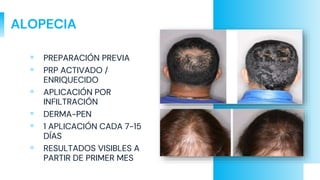 ALOPECIA
▫ PREPARACIÓN PREVIA
▫ PRP ACTIVADO /
ENRIQUECIDO
▫ APLICACIÓN POR
INFILTRACIÓN
▫ DERMA-PEN
▫ 1 APLICACIÓN CADA 7-15
DÍAS
▫ RESULTADOS VISIBLES A
PARTIR DE PRIMER MES
 