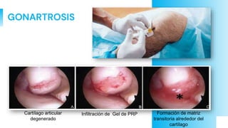 GONARTROSIS
Cartílago articular
degenerado
Infiltración de Gel de PRP Formación de matriz
transitoria alrededor del
cartílago
 
