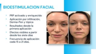 BIOESTIMULACION FACIAL
▫ PRP activado y enriquecido
▫ Aplicación por infiltración,
Derma-Pen y tópica
▫ Resultados desde la
primera aplicación
▫ Efectos visibles a partir
desde los siete días
▫ Frecuencia de aplicación:
cada 15 a 21 días.
 
