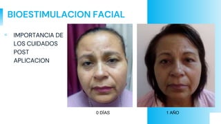 BIOESTIMULACION FACIAL
▫ IMPORTANCIA DE
LOS CUIDADOS
POST
APLICACION
0 DÍAS 1 AÑO
 