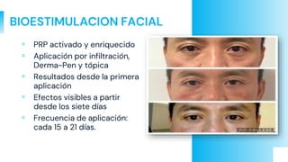 BIOESTIMULACION FACIAL
▫ PRP activado y enriquecido
▫ Aplicación por infiltración,
Derma-Pen y tópica
▫ Resultados desde la primera
aplicación
▫ Efectos visibles a partir
desde los siete días
▫ Frecuencia de aplicación:
cada 15 a 21 días.
 