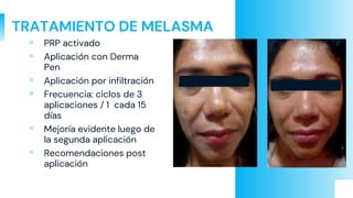 TRATAMIENTO DE MELASMA
▫ PRP activado
▫ Aplicación con Derma
Pen
▫ Aplicación por infiltración
▫ Frecuencia: ciclos de 3
aplicaciones / 1 cada 15
días
▫ Mejoría evidente luego de
la segunda aplicación
▫ Recomendaciones post
aplicación
 
