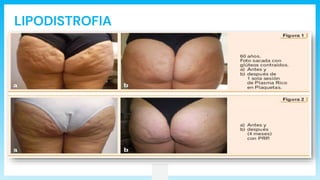 LIPODISTROFIA
 