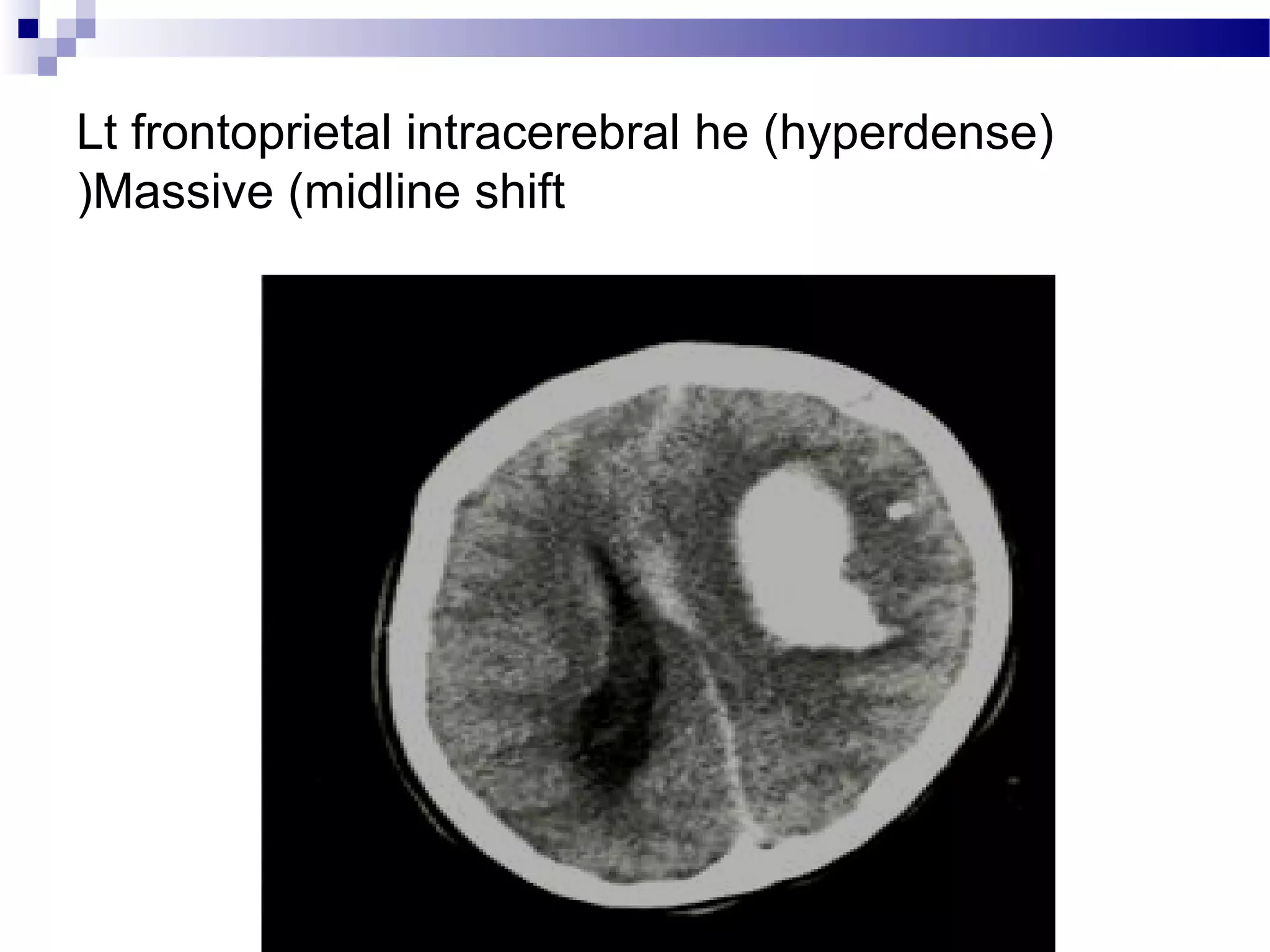 Lt frontoprietal intracerebral he (hyperdense(
Massive (midline shift(
 