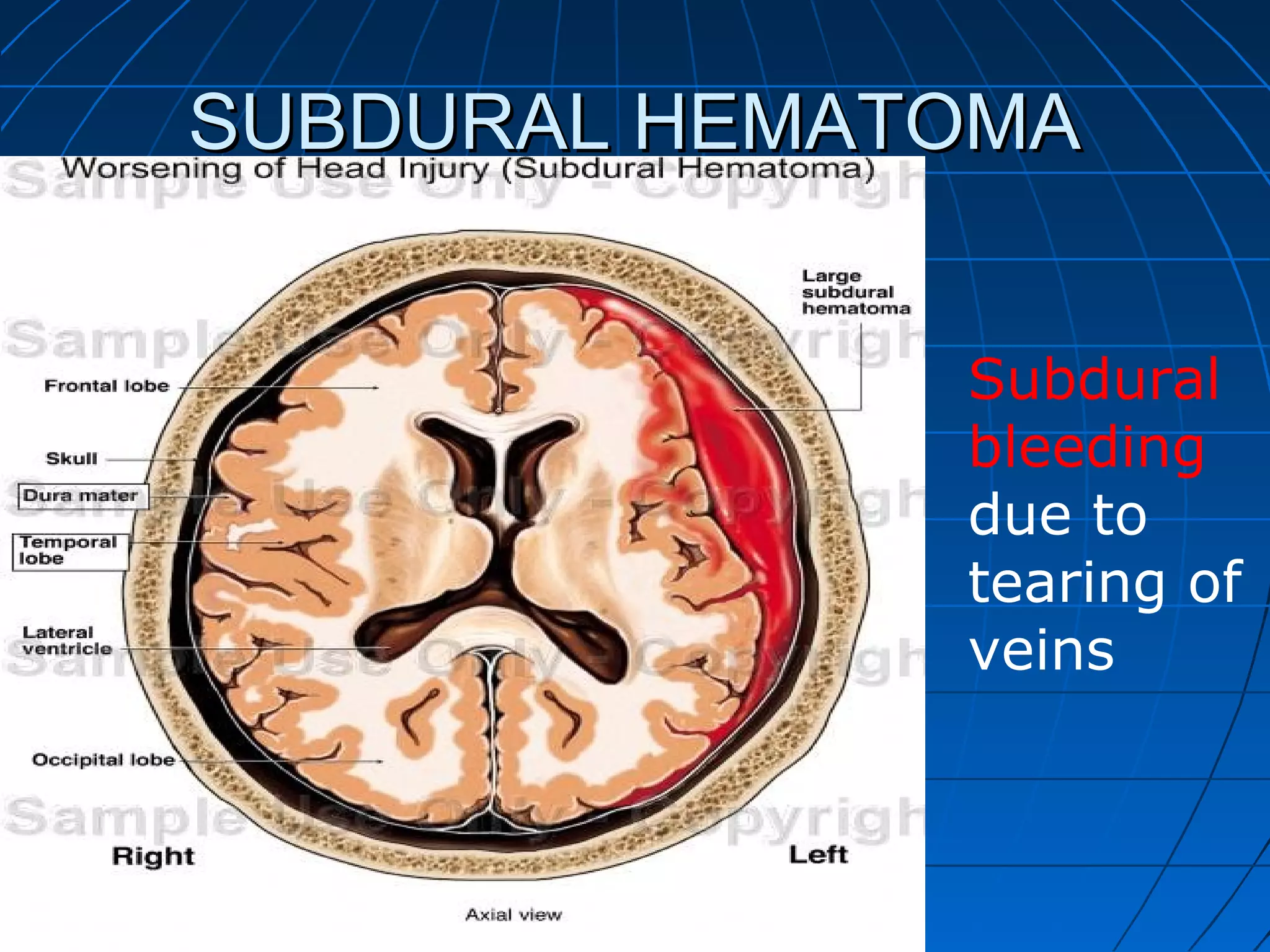 SUBDURAL HEMATOMASUBDURAL HEMATOMA
Subdural
bleeding
due to
tearing of
veins
 
