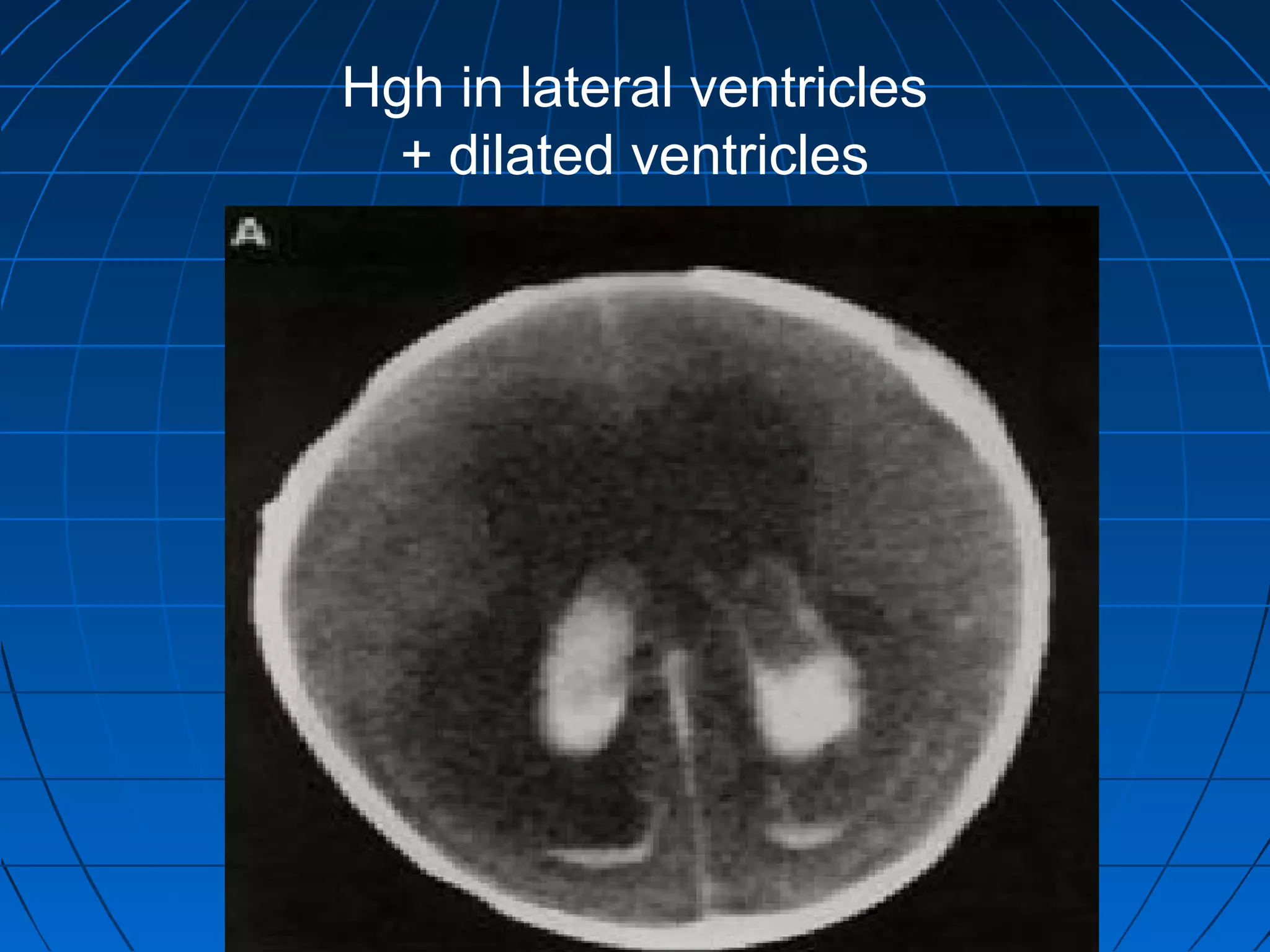 Hgh in lateral ventricles
+ dilated ventricles
 